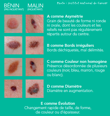 Tableau evolution risque grains de beauté